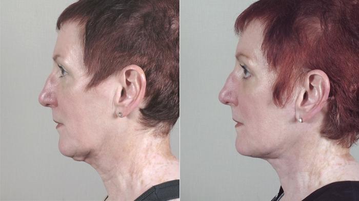 Neck Contouring Case 1171 Before & After View 1  | Paramus, New Jersey | Parker Center for Plastic Surgery