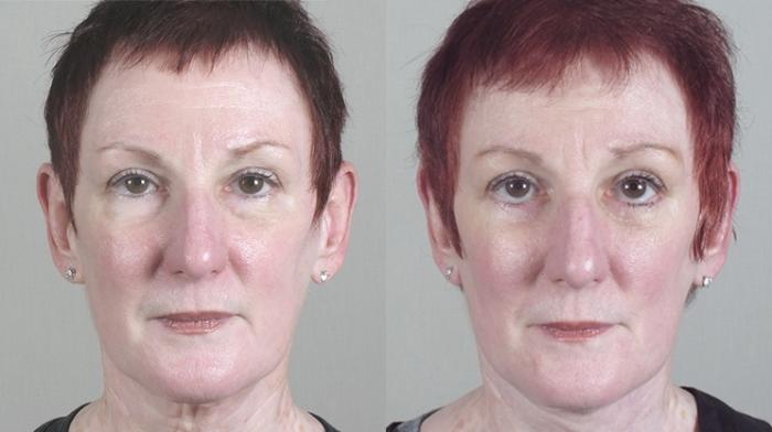 Neck Contouring Case 1171 Before & After View 2 | Paramus, New Jersey | Parker Center for Plastic Surgery