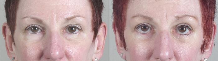 Neck Contouring Case 1171 Before & After View 3 | Paramus, New Jersey | Parker Center for Plastic Surgery