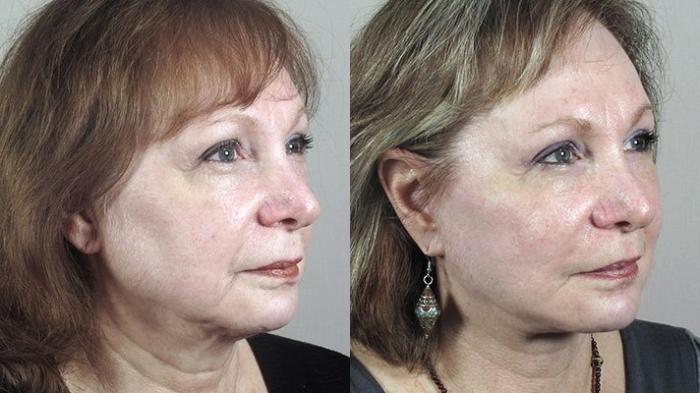 Neck Contouring Case 1179 Before & After View 1  | Paramus, New Jersey | Parker Center for Plastic Surgery