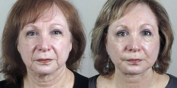 Neck Contouring Case 1179 Before & After View 2 | Paramus, New Jersey | Parker Center for Plastic Surgery