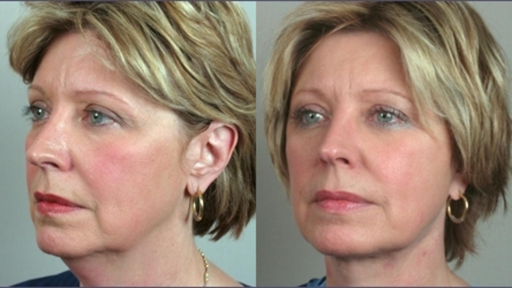 Neck Contouring Case 1182 Before & After View 1  | Paramus, New Jersey | Parker Center for Plastic Surgery