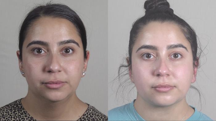 Neck Contouring Case 1215 Before & After View #1  | Paramus, New Jersey | Parker Center for Plastic Surgery