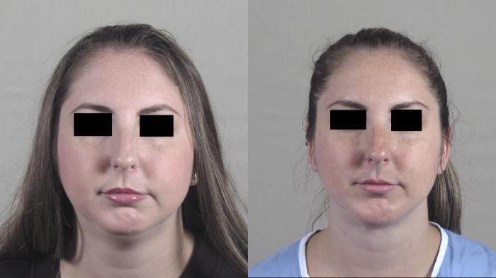 Neck Contouring Case 1251 Before & After Front | Paramus, New Jersey | Parker Center for Plastic Surgery