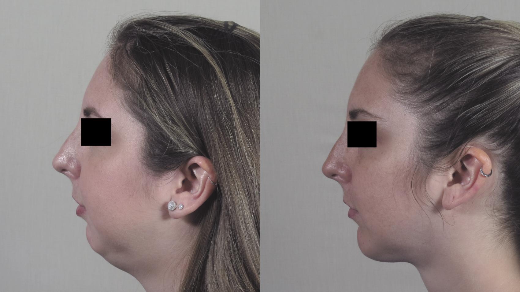 Neck Contouring Case 1251 Before & After Left Side | Paramus, New Jersey | Parker Center for Plastic Surgery