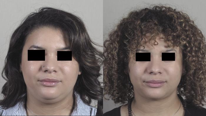 Neck Contouring Case 1305 Before & After Front | Paramus, New Jersey | Parker Center for Plastic Surgery