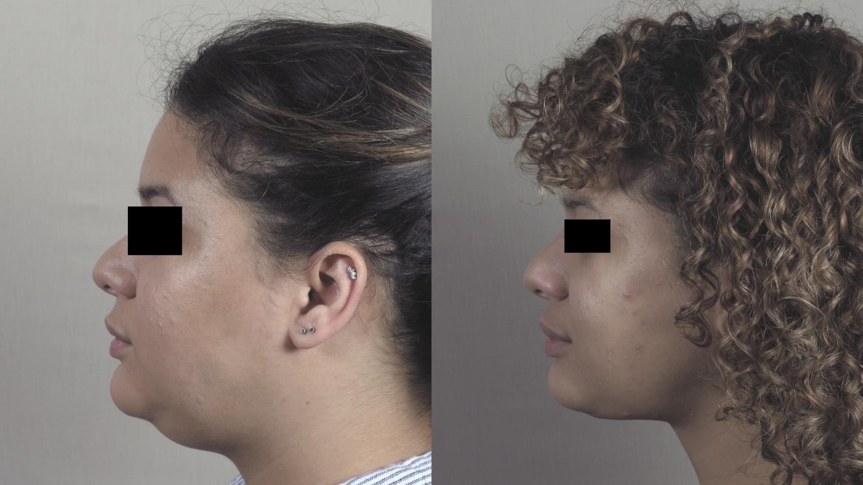 Neck Contouring Case 1305 Before & After Left Side | Paramus, New Jersey | Parker Center for Plastic Surgery