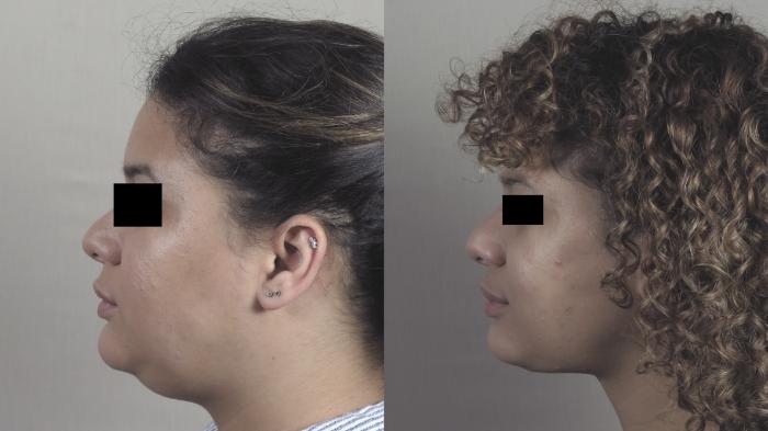 Neck Contouring Case 1305 Before & After Left Side | Paramus, New Jersey | Parker Center for Plastic Surgery
