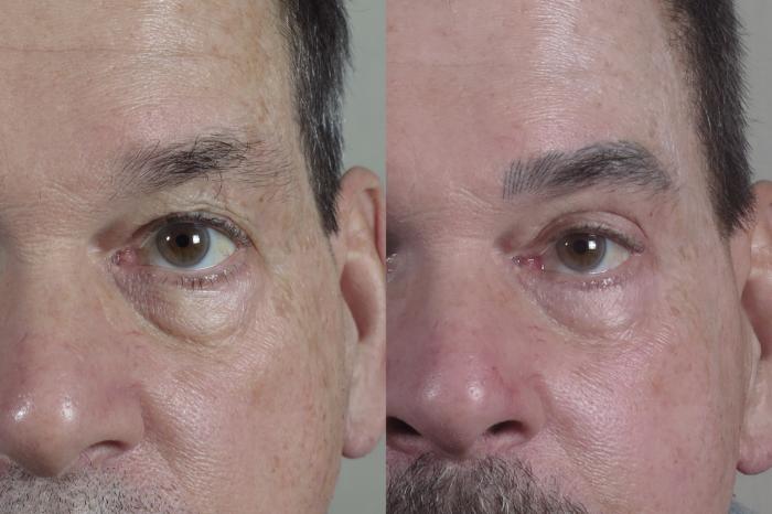 Neck Contouring Case 1325 Before & After front zoomed view  | Paramus, New Jersey | Parker Center for Plastic Surgery