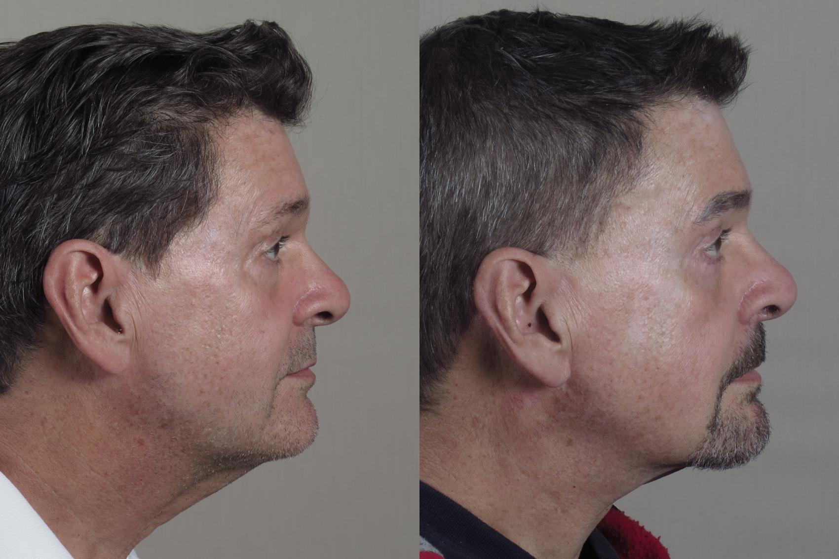Neck Contouring Case 1325 Before & After Left Side | Paramus, New Jersey | Parker Center for Plastic Surgery