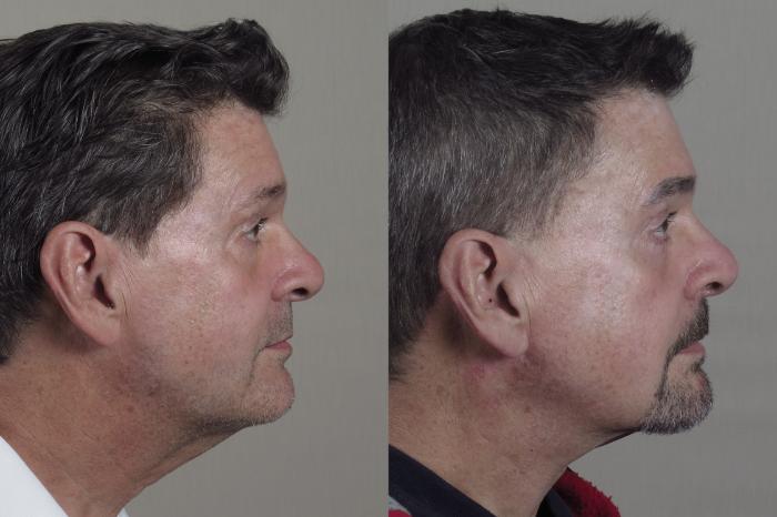 Neck Contouring Case 1325 Before & After Left Side | Paramus, New Jersey | Parker Center for Plastic Surgery