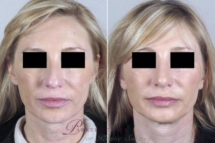 Neck Contouring Case 1380 Before & After Front | Paramus, New Jersey | Parker Center for Plastic Surgery