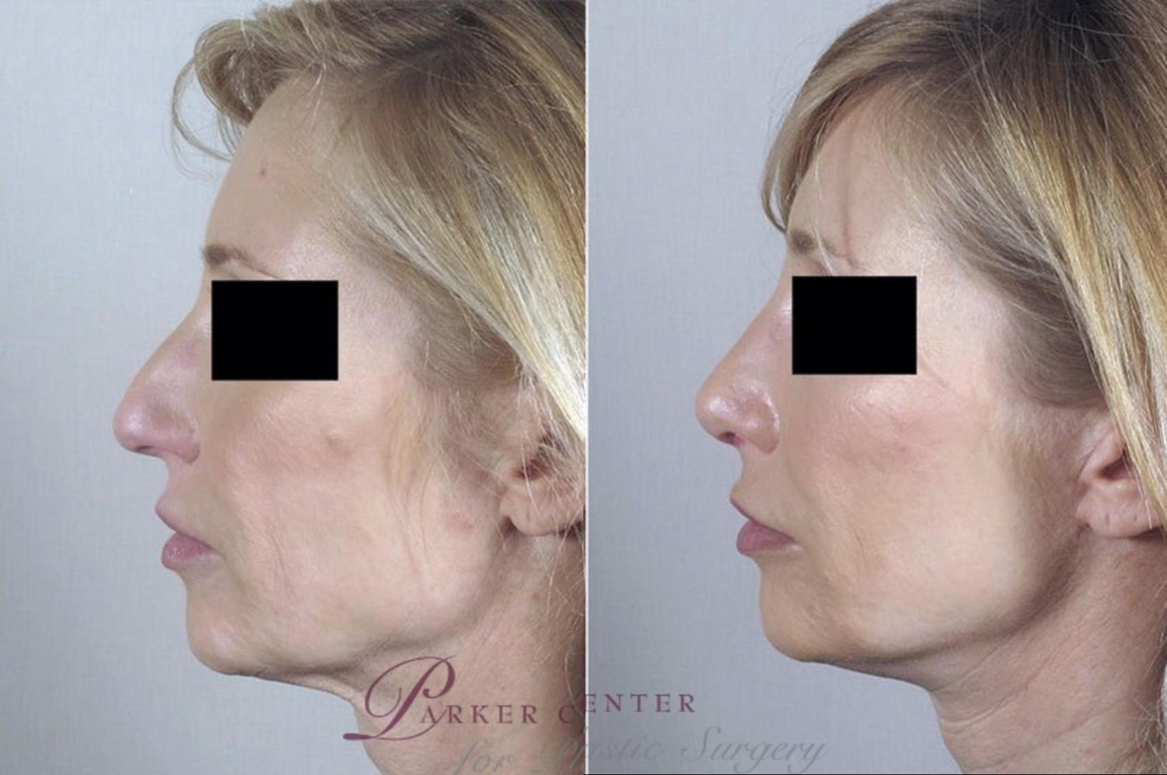Neck Contouring Case 1380 Before & After Left Side | Paramus, New Jersey | Parker Center for Plastic Surgery