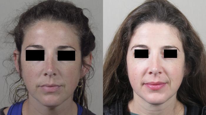 Neck Contouring Case 1526 Before & After Front | Paramus, New Jersey | Parker Center for Plastic Surgery