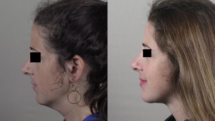 Neck Contouring Case 1526 Before & After Left Side | Paramus, New Jersey | Parker Center for Plastic Surgery