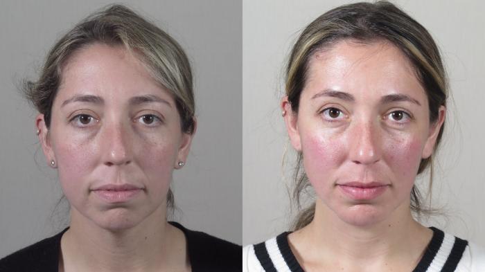 Neck Contouring Case 1544 Before & After Front | Paramus, New Jersey | Parker Center for Plastic Surgery