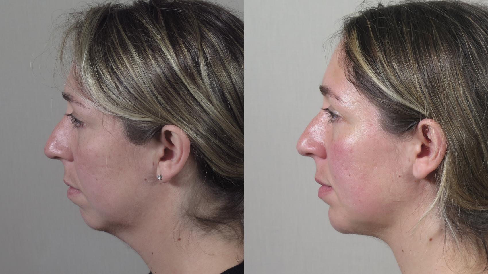 Neck Contouring Case 1544 Before & After Left Side | Paramus, New Jersey | Parker Center for Plastic Surgery
