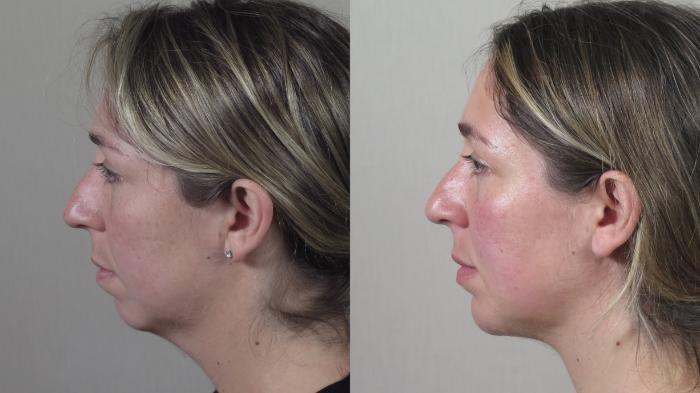 Neck Contouring Case 1544 Before & After Left Side | Paramus, New Jersey | Parker Center for Plastic Surgery