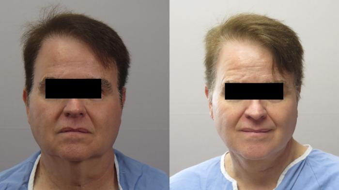 Neck Contouring Case 1659 Before & After Front | Paramus, New Jersey | Parker Center for Plastic Surgery