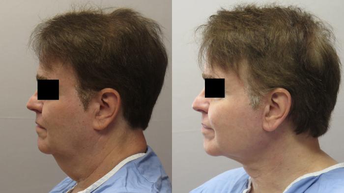 Neck Contouring Case 1659 Before & After Left Side | Paramus, New Jersey | Parker Center for Plastic Surgery