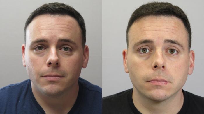 Neck Contouring Case 1672 Before & After Front | Paramus, New Jersey | Parker Center for Plastic Surgery
