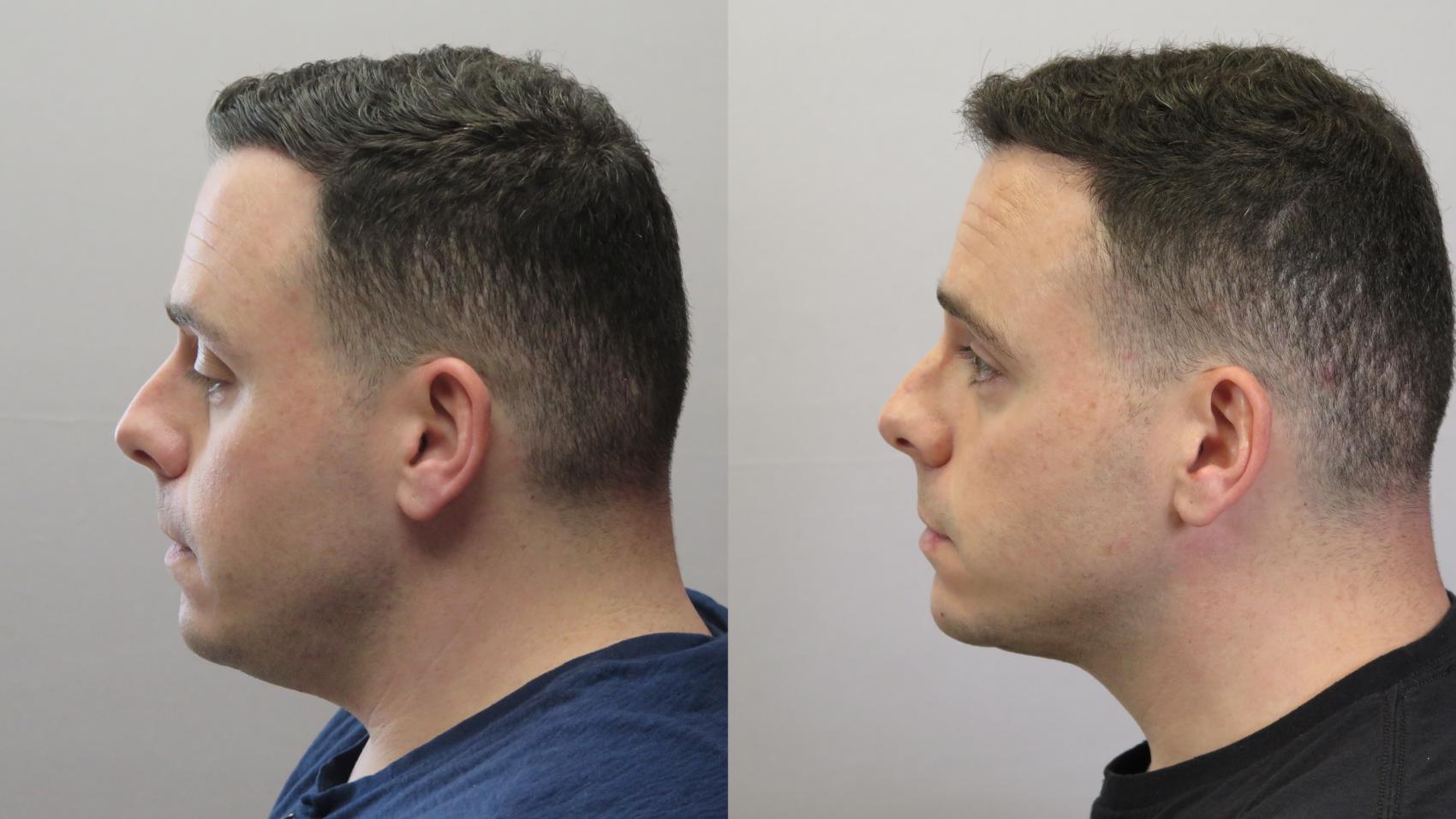 Neck Contouring Case 1672 Before & After Left Side | Paramus, New Jersey | Parker Center for Plastic Surgery