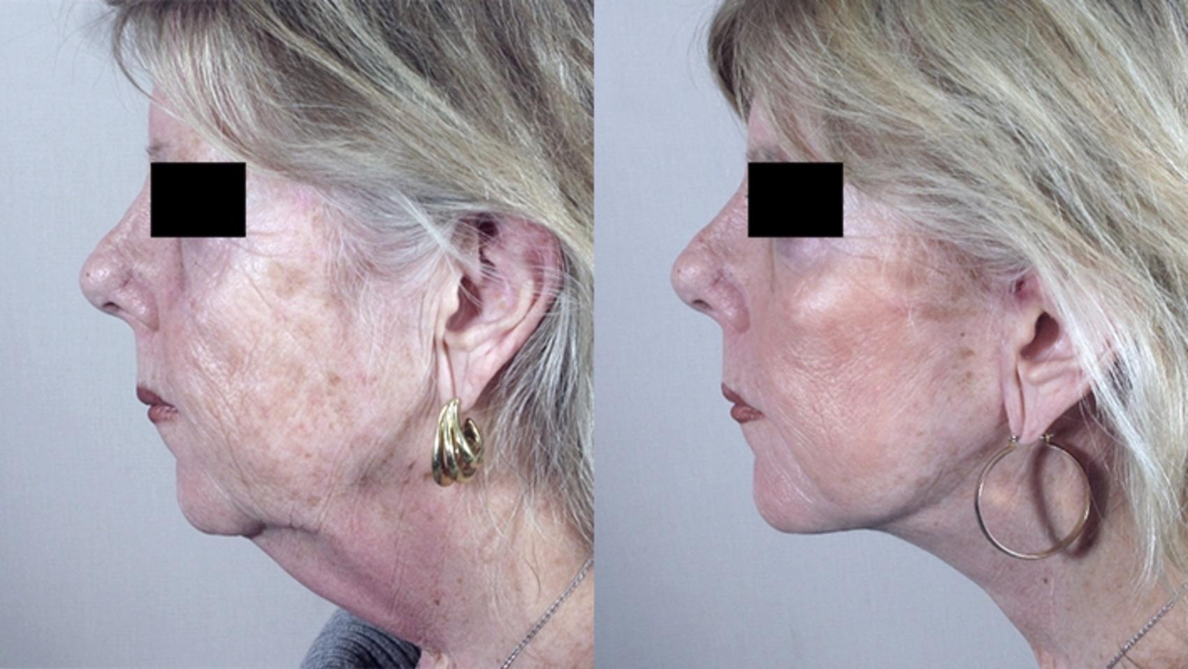 Facelift Case 18 Before & After View #1 | Paramus, New Jersey | Parker Center for Plastic Surgery