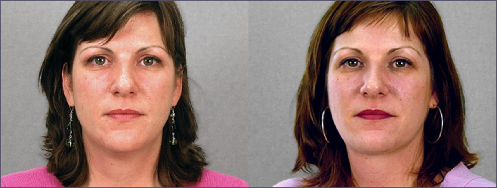 Neck Contouring Case 209 Before & After View #1 | Paramus, New Jersey | Parker Center for Plastic Surgery