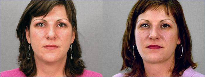 Neck Contouring Case 209 Before & After View #1 | Paramus, New Jersey | Parker Center for Plastic Surgery