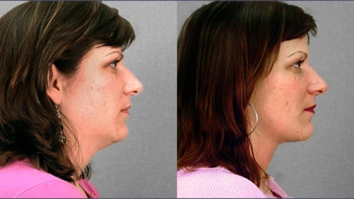 Neck Contouring Case 209 Before & After View #2 | Paramus, New Jersey | Parker Center for Plastic Surgery