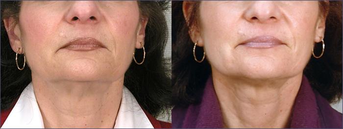 Neck Contouring Case 210 Before & After View #1 | Paramus, New Jersey | Parker Center for Plastic Surgery