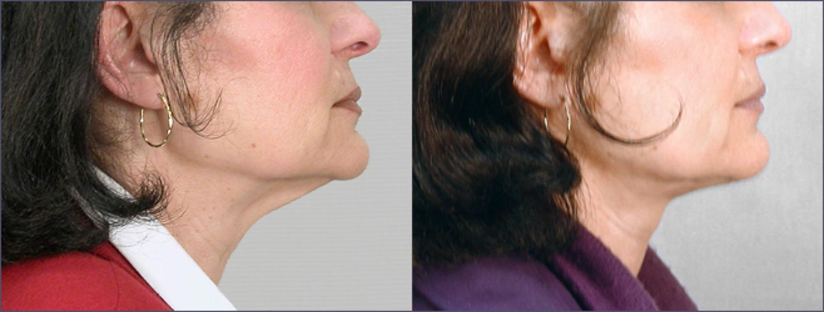 Neck Contouring Case 210 Before & After View #2 | Paramus, New Jersey | Parker Center for Plastic Surgery