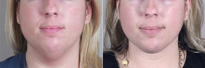 Neck Contouring Case 212 Before & After View #1 | Paramus, New Jersey | Parker Center for Plastic Surgery