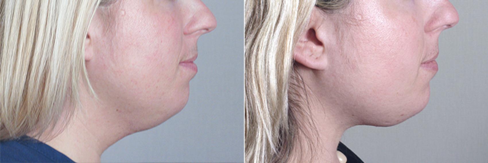 Neck Contouring Case 212 Before & After View #2 | Paramus, New Jersey | Parker Center for Plastic Surgery