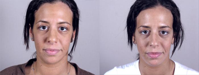 Neck Contouring Case 213 Before & After View #1 | Paramus, New Jersey | Parker Center for Plastic Surgery
