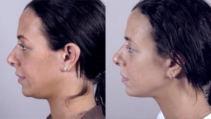 Neck Contouring Case 213 Before & After View #2 | Paramus, New Jersey | Parker Center for Plastic Surgery