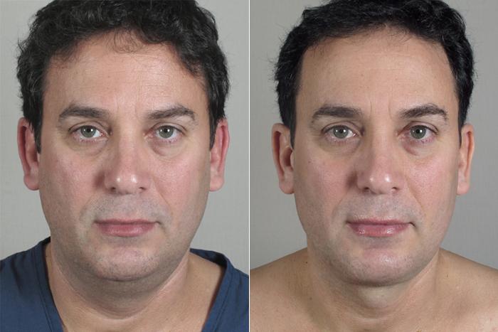 Neck Contouring Case 215 Before & After View #1 | Paramus, New Jersey | Parker Center for Plastic Surgery
