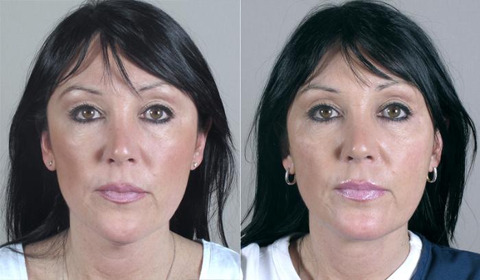 Neck Contouring Case 217 Before & After View #1 | Paramus, New Jersey | Parker Center for Plastic Surgery