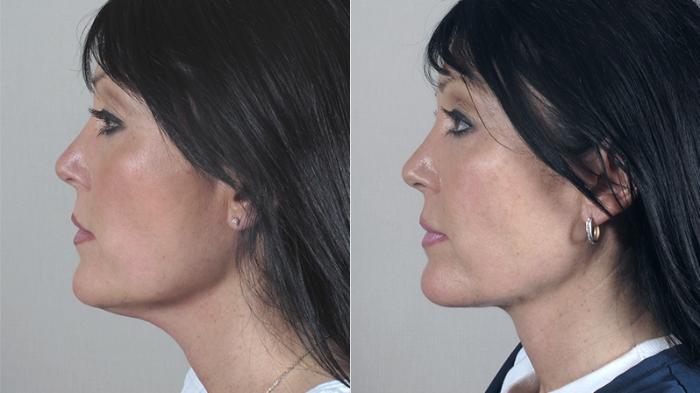 Neck Contouring Case 217 Before & After View #2 | Paramus, New Jersey | Parker Center for Plastic Surgery
