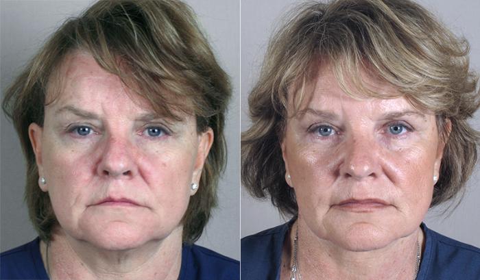 Neck Contouring Case 218 Before & After View #1 | Paramus, New Jersey | Parker Center for Plastic Surgery