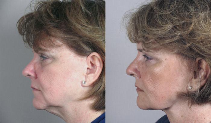 Neck Contouring Case 218 Before & After View #2 | Paramus, New Jersey | Parker Center for Plastic Surgery