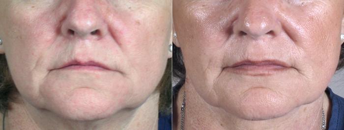 Neck Contouring Case 218 Before & After View #3 | Paramus, New Jersey | Parker Center for Plastic Surgery