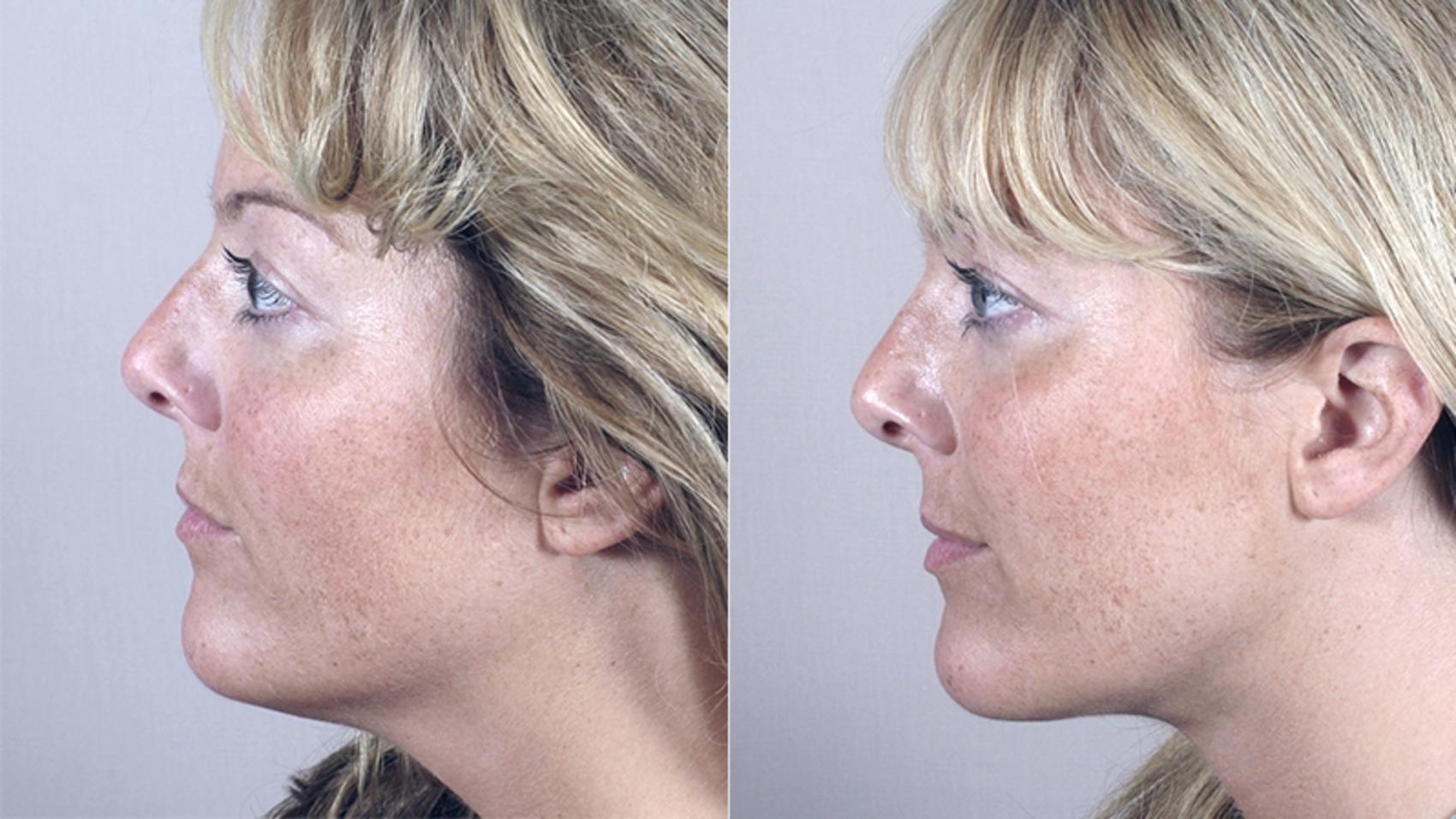 Neck Contouring Case 219 Before & After View #1 | Paramus, New Jersey | Parker Center for Plastic Surgery