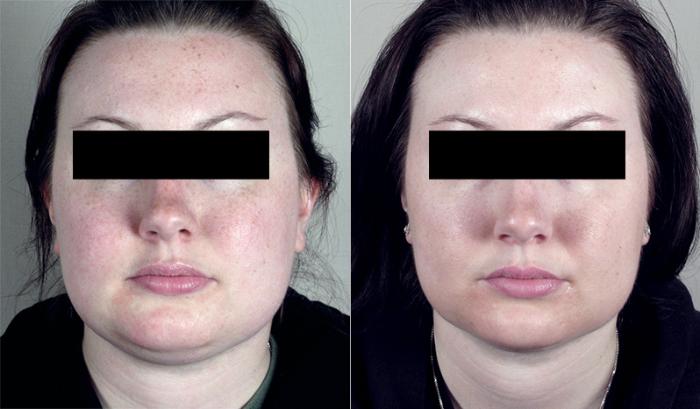 Neck Contouring Case 220 Before & After View #1 | Paramus, New Jersey | Parker Center for Plastic Surgery