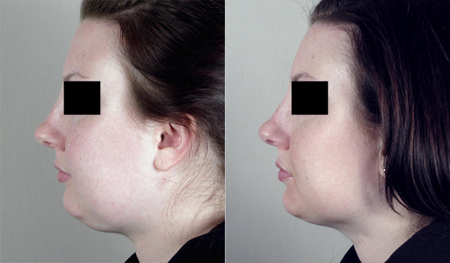 Neck Contouring Case 220 Before & After View #2 | Paramus, New Jersey | Parker Center for Plastic Surgery