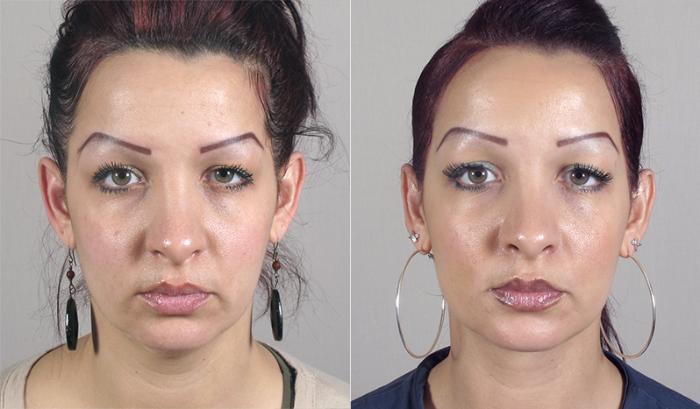Neck Contouring Case 221 Before & After View #1 | Paramus, New Jersey | Parker Center for Plastic Surgery