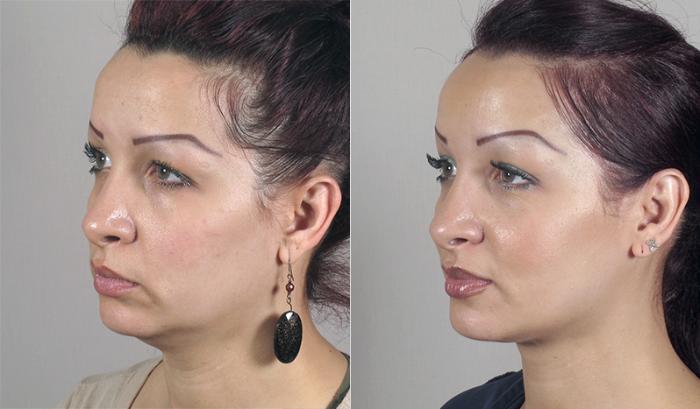 Neck Contouring Case 221 Before & After View #2 | Paramus, New Jersey | Parker Center for Plastic Surgery