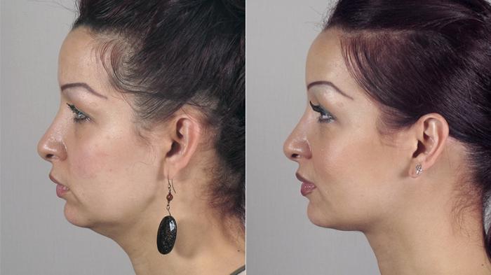 Neck Contouring Case 221 Before & After View #3 | Paramus, New Jersey | Parker Center for Plastic Surgery