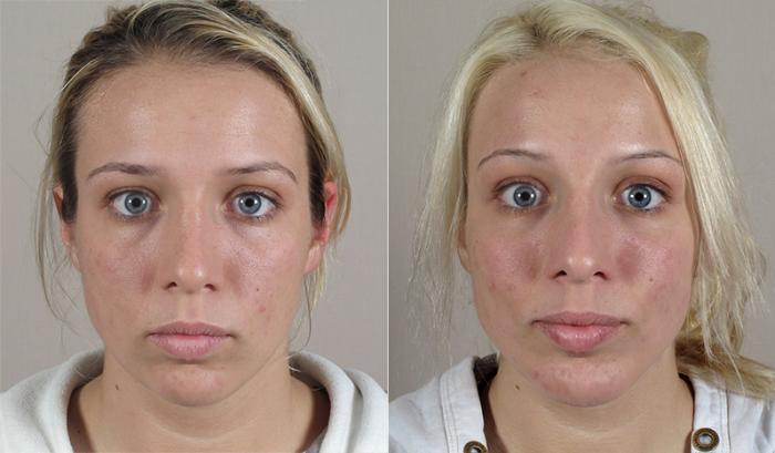 Chin Implants Case 222 Before & After View #1 | Paramus, New Jersey | Parker Center for Plastic Surgery