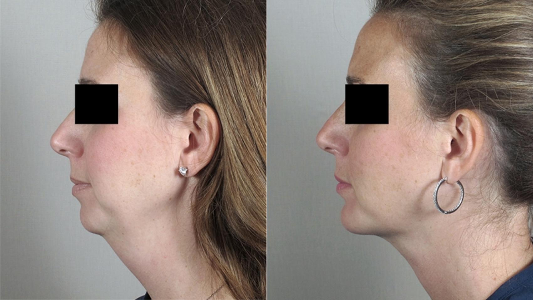 Neck Contouring Case 223 Before & After View #1 | Paramus, New Jersey | Parker Center for Plastic Surgery